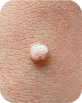 점, 지루성각화증(검버섯), 피부섬유종, 피지샘과증식증, 사마귀, 한관종