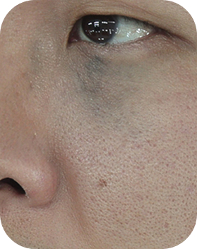 오타모반, 후천성양측성오타모반양반점